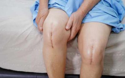 Arthritis Patients: Do You Need Surgery?